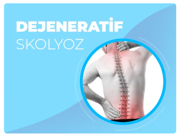 Dejeneratif skolyoz tedavi yöntemi ile ilgili makale ve videolar