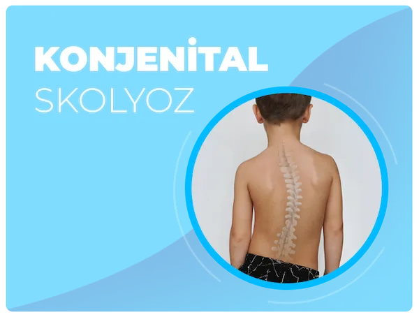 Konjenital skolyoz tedavi yöntemi ile ilgili makale ve videolar