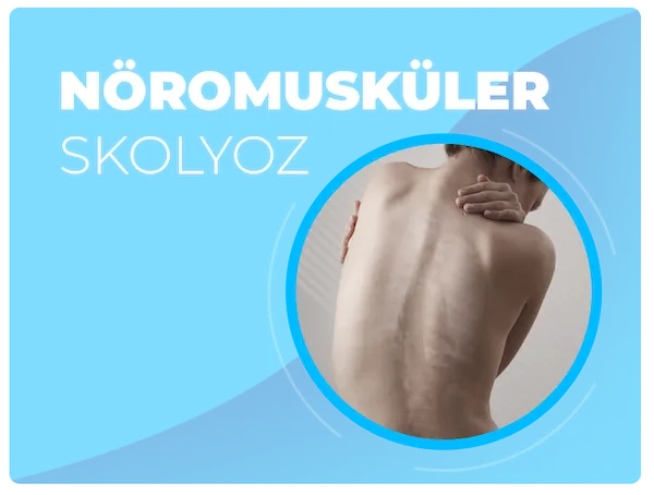 Nöromusküler skolyoz tedavi yöntemi ile ilgili makale ve videolar
