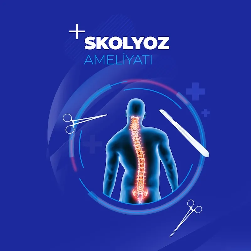 Skolyoz tedavi yöntemleri ile ilgili makale ve videolar