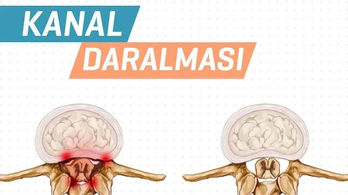 Omurga kanal daralması belirtileri nelerdir