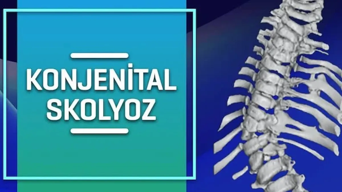 Doğuştan olan skolyozun belirtileri nelerdir
