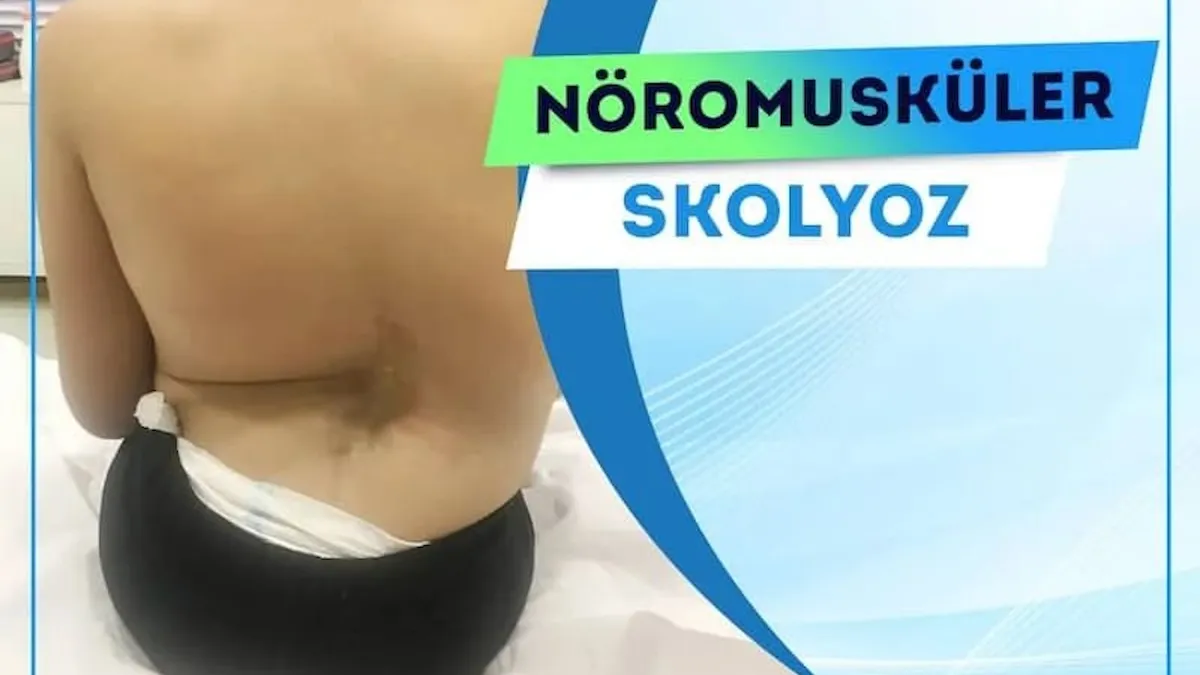 Nöromusküler skolyoz belirtileri nelerdir